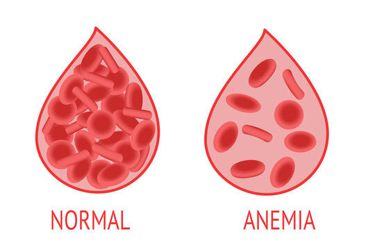 Anemia