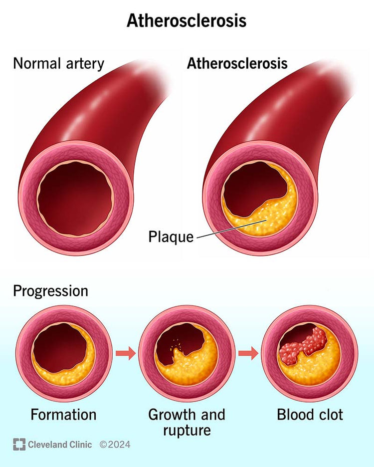 Arteriosclerosis
