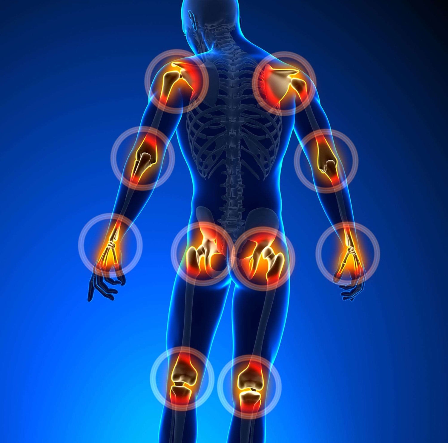Arthritis