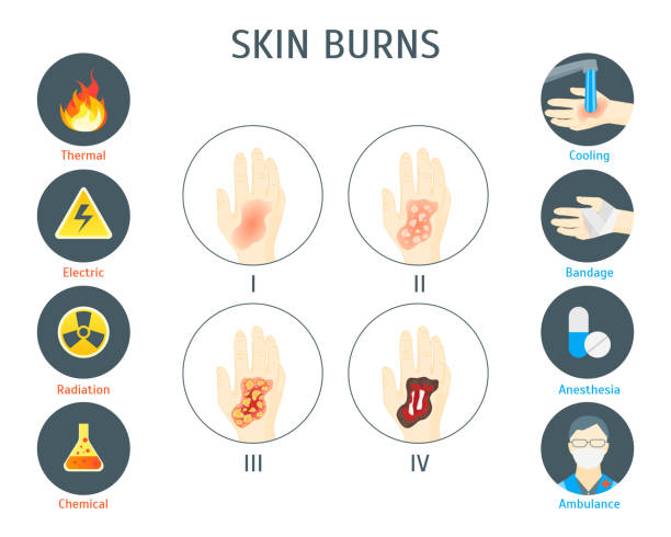 Burns