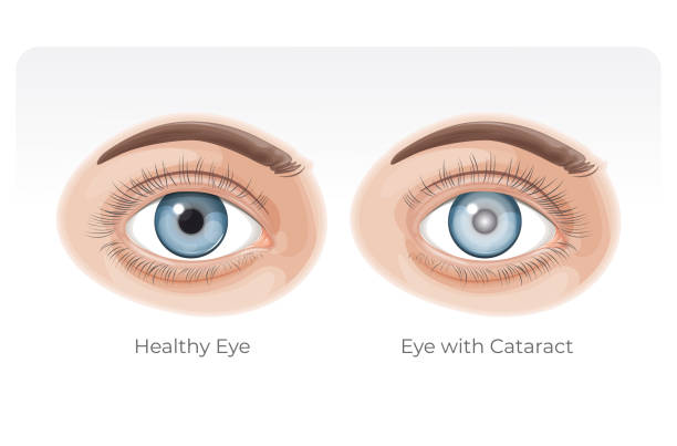Cataracts