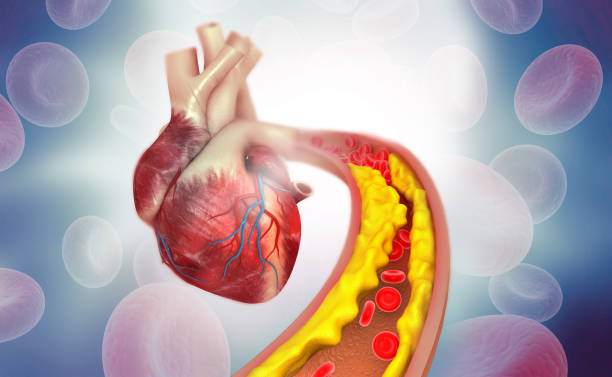 Cholesterol Issues
