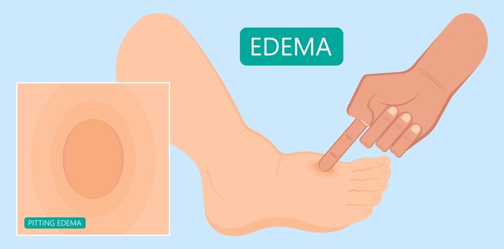 Edema