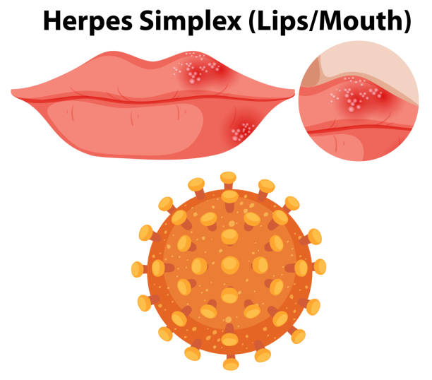 Herpes