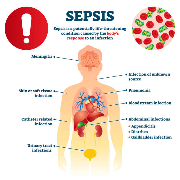 Sepsis